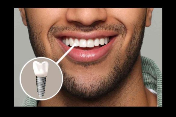 What Are Perfect Teeth Supposed To Look Like