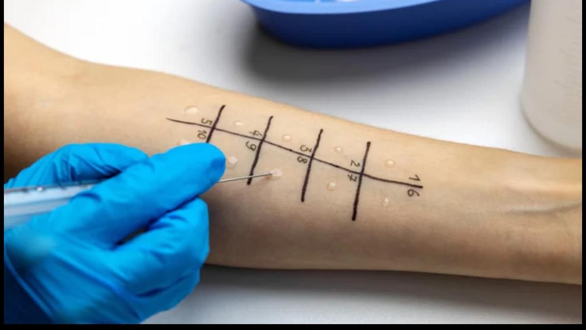 What Are The Different Allergy Tests?