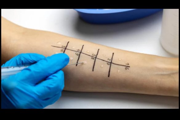 What Are The Different Allergy Tests?